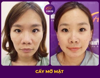 CẤY MỠ